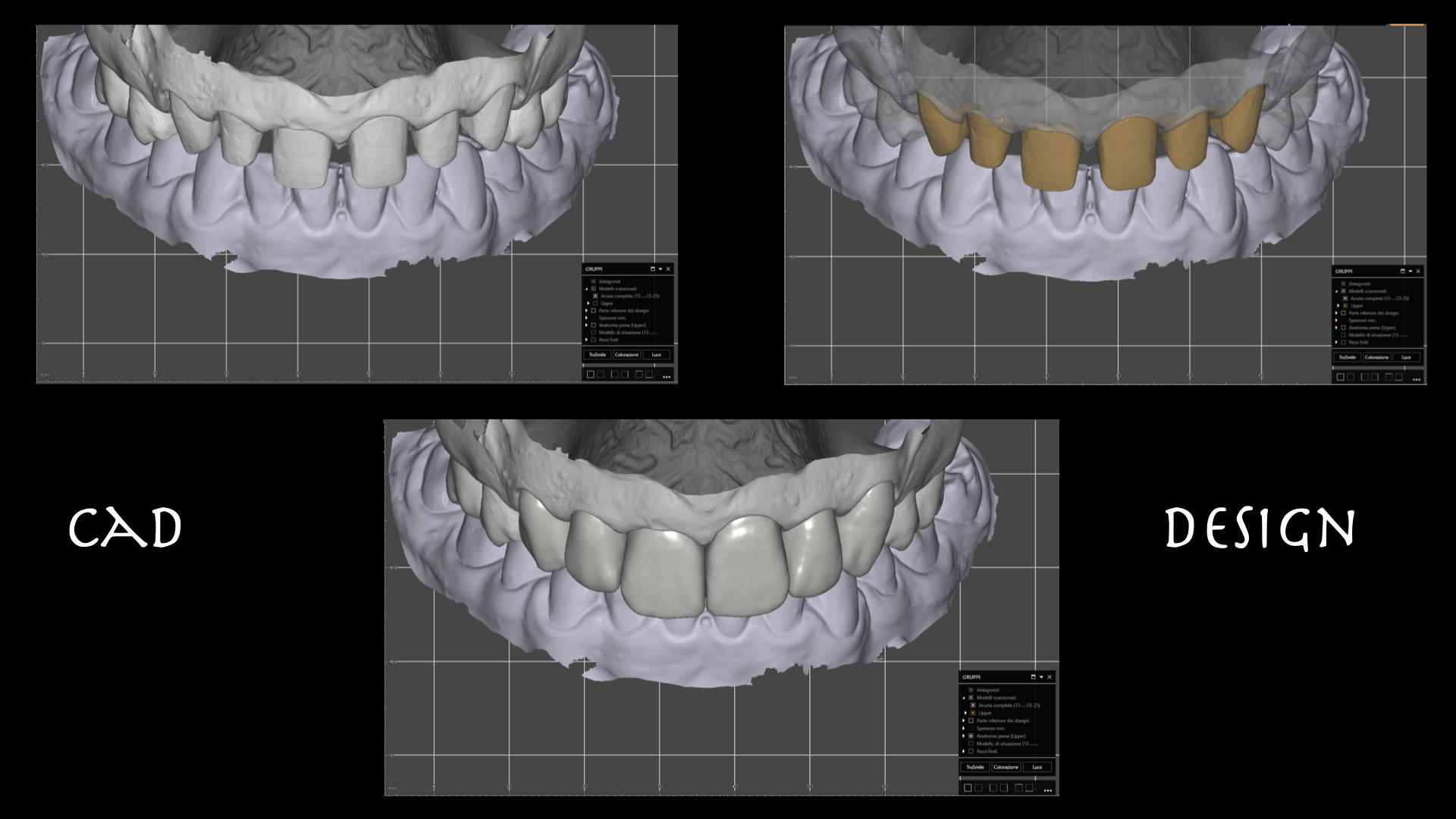 CAD Design — Faccette e corone