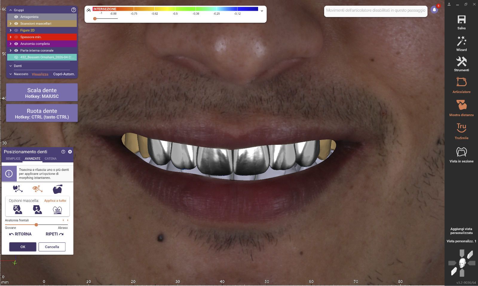 Smile Design — Ceratura diagnostica